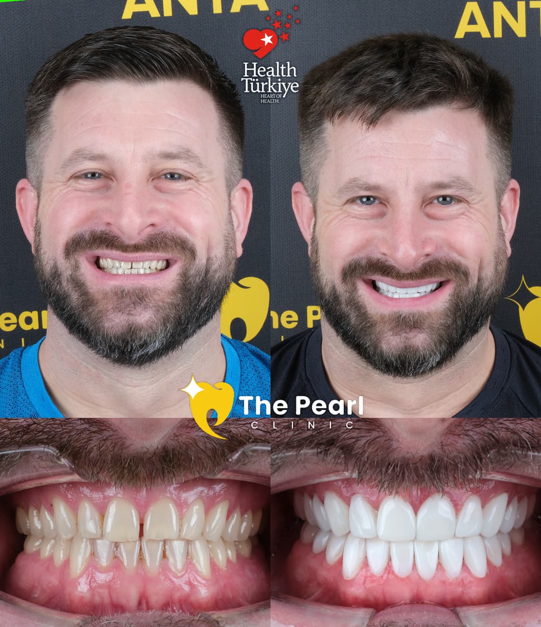 Composite Veneers Before and After Turkey